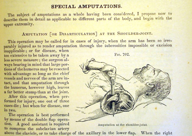 amputations or disarticulation